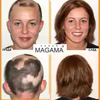 Решения за алопеция в салон Магама (Снимки)