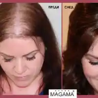 Решения за алопеция в салон Магама (Снимки)