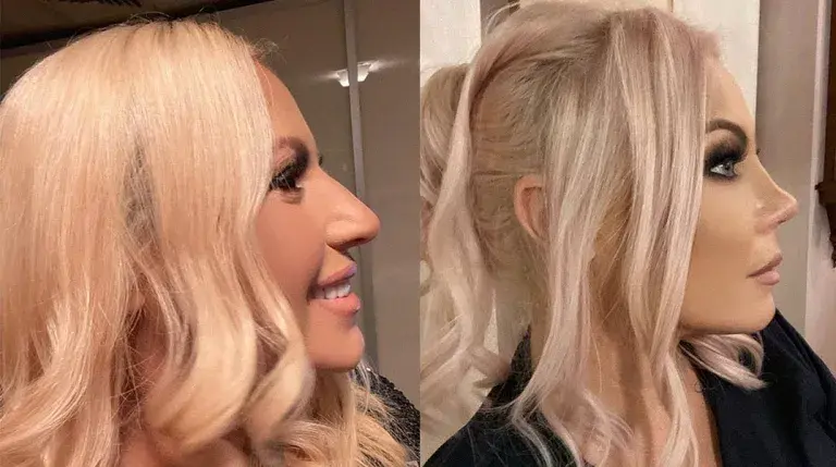 След ринопластиката на Преслава, феновете пак са в шок:  Камелия, защо?