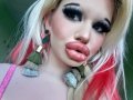 Бг Барби след 25 инжекции хиалурон в устните: Има риск да ослепея!