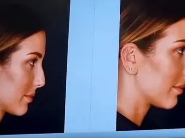 Алекс Петканова показа новия нос