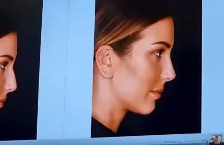 Алекс Петканова показа новия нос