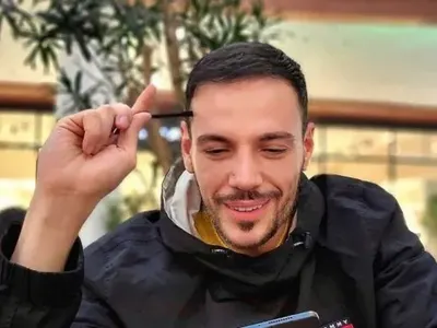 Даниел Петканов си сложи имплант и в брадичката