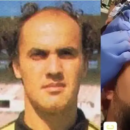 Мъжка суета! Родни актьори и футболист най-често си присаждат коса! Вижте кои са