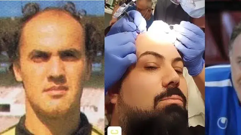 Мъжка суета! Родни актьори и футболист най-често си присаждат коса! Вижте кои са