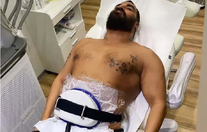 Азис топи тлъстини с липосукция