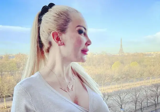 Тоца се окепази с филъри, лицето й стана на бабуни