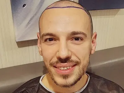 Даниел Петканов си присади коса, но тя не порасна