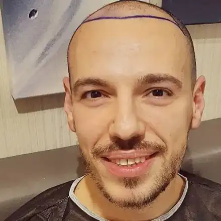 Даниел Петканов си присади коса, но тя не порасна