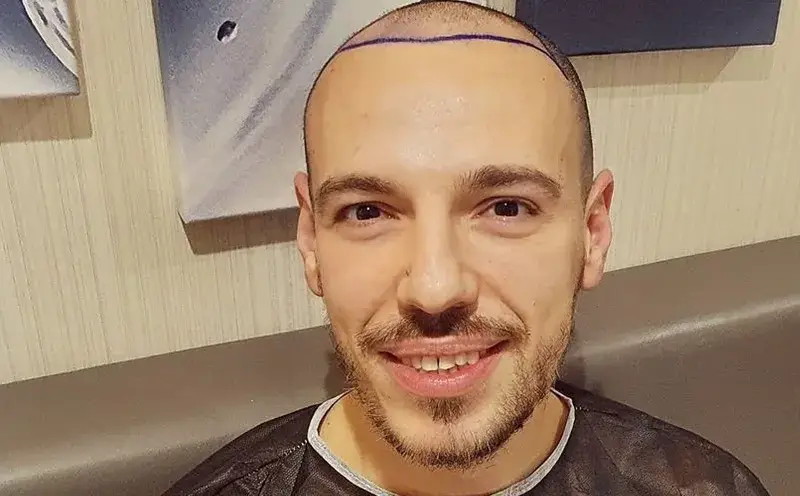 Даниел Петканов си присади коса, но тя не порасна