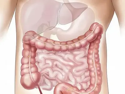 Гастроентеролог посочи най-вредния продукт, причиняващ рак