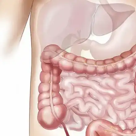 Гастроентеролог посочи най-вредния продукт, причиняващ рак