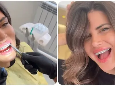 Ергенката Боряна сложи брекети