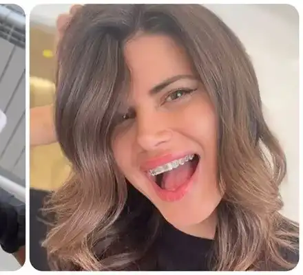 Ергенката Боряна сложи брекети