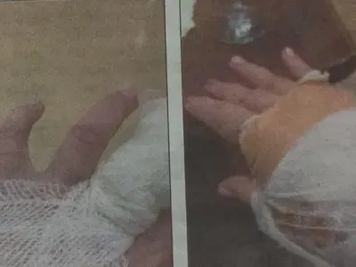 Кучето на Катя Близнакова  й отхапа ръката, закърпиха я с 15 шева в „Пирогов” СНИМКИ