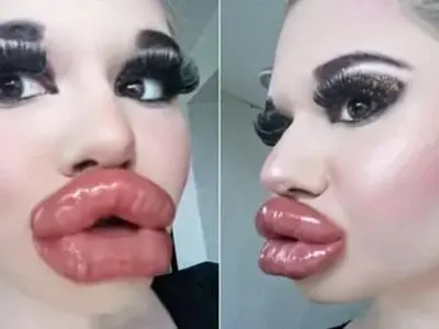 Лекарят, който помпа устните на БГ Барби вдигна ръце: Спри, ще получиш некроза! (СНИМКИ)