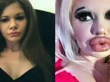 Лекарят, който помпа устните на БГ Барби вдигна ръце: Спри, ще получиш некроза! (СНИМКИ)