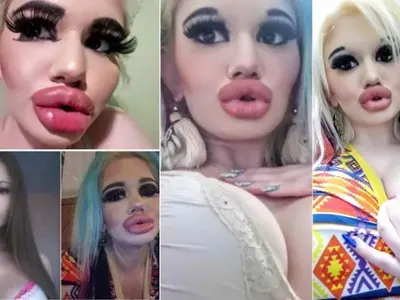 Лекарят, който помпа устните на БГ Барби вдигна ръце: Спри, ще получиш некроза! (СНИМКИ)