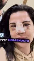 ВАРВАРСКА ринопластика окепази лицето на Ивка Бейбе (СНИМКИ)