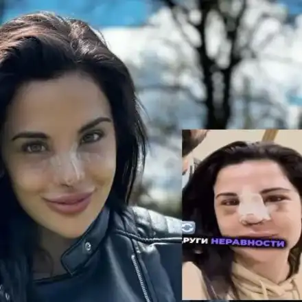 Ето го новия нос на Ивка Бейбе! (ВНИМАНИЕ: Смущаващи снимки)