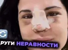 ВАРВАРСКА ринопластика окепази лицето на Ивка Бейбе (СНИМКИ)