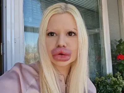 Дейли мейл гръмна: Българката с най-големи устни в света пред ЗАПЛАХА от некроза! СНИМКИ