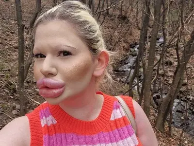 Дейли мейл гръмна: Българката с най-големи устни в света пред ЗАПЛАХА от некроза! СНИМКИ