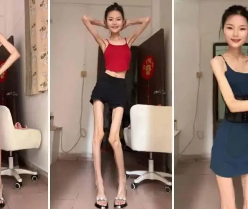 Най-страшната анорексия! Трийсет и кусур годишна тежи 25 кг, сваля още