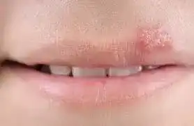 Ужас - пак херпес? Ето го решението, което ще ви избави от мъките