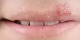 Ужас - пак херпес? Ето го решението, което ще ви избави от мъките
