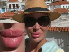 Кофти хиалурон обезобрази Антония Петрова! Вижте какво си причини