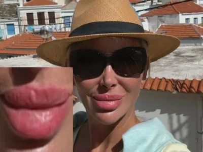 Кофти хиалурон обезобрази Антония Петрова! Вижте какво си причини