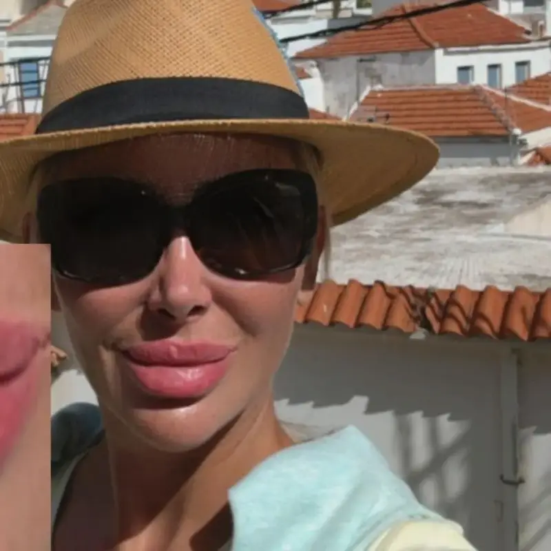 Кофти хиалурон обезобрази Антония Петрова! Вижте какво си причини