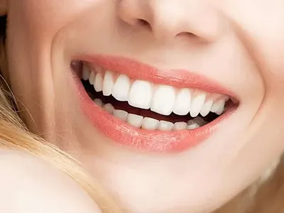 Професионално или домашно избелване на зъби: Коя опция е най-подходяща за вас?