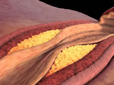 За да свалите "лошия" холестерол, е необходимо да...