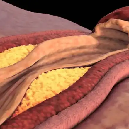 За да свалите "лошия" холестерол, е необходимо да...