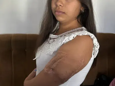 Болката на една тийнейджърка: Катя се бори за живота на ръката си