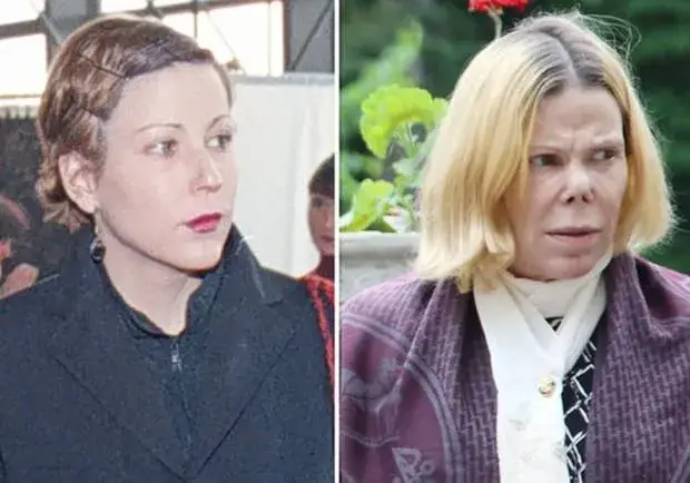 Зъбна инфекция заради лекарска грешка увреди лицето на Калина