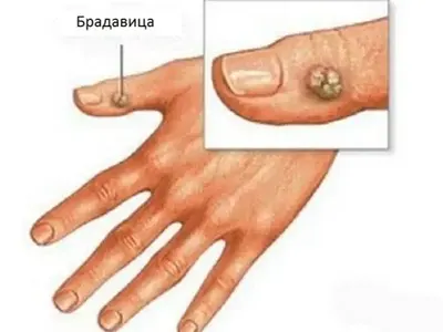 Може ли брадавиците да изчезнат сами?