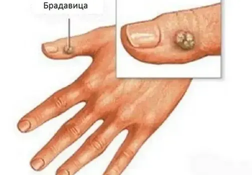 Може ли брадавиците да изчезнат сами?