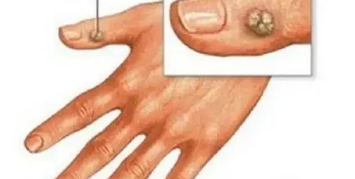 Може ли брадавиците да изчезнат сами?