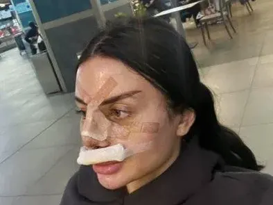 Бистра от "Островът" си клъцна носа като Галена и Богданска СНИМКИ