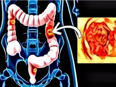 Колко време живеят хората с диагноза рак на дебелото черво?