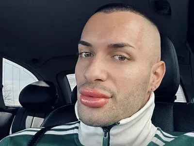 Младежи нападнаха щангиста Захари Георгиев – заради хиалурона в устните му ВИДЕО