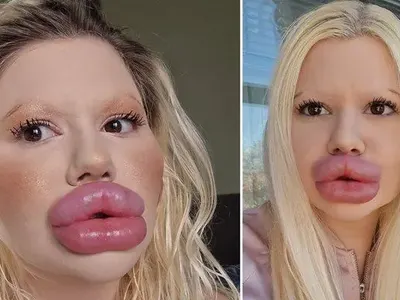 Тресе я шубето: БГ Барби спря процедурите след ботокс скандала