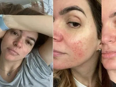 Ива Софиянска  се бори с розацея