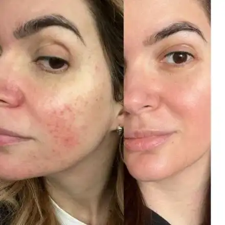 Ива Софиянска  се бори с розацея