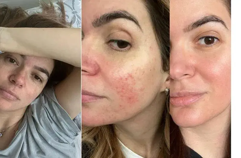 Ива Софиянска  се бори с розацея