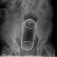 Лекари от „Пирогов“ извадиха дезодорант от д*пето на 14-годишно момче