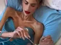 Анорексия докарва риалити звезда до 22 кг и я убива